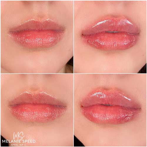 Lip Augmentation Before & After Photos by Flawless Medspa in Las Vegas NV