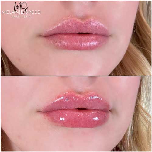 Lip Augmentation Before & After Photos by Flawless Medspa in Las Vegas NV