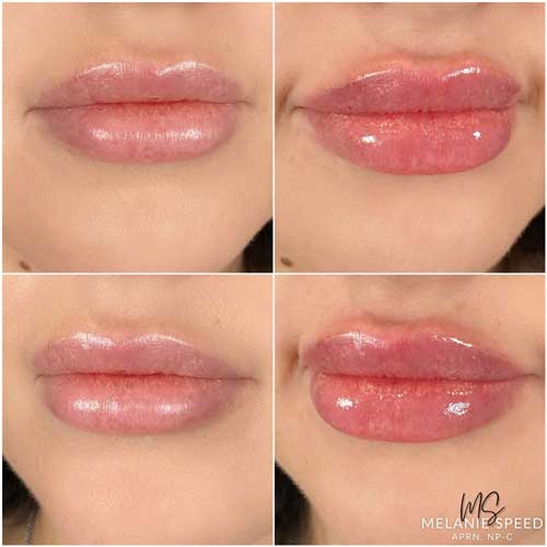 Lip Augmentation Before & After Photos by Flawless Medspa in Las Vegas NV