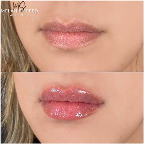 Lip Augmentation Before & After Photos by Flawless Medspa in Las Vegas NV