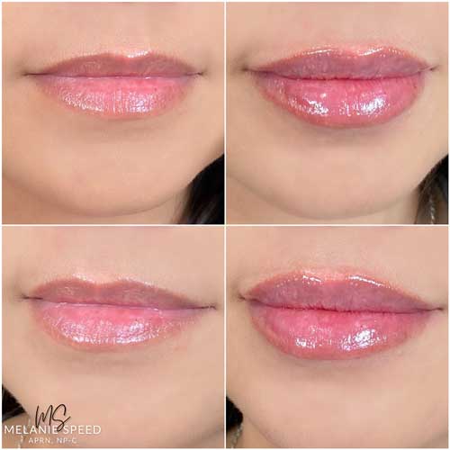 Lip Augmentation Before & After Photos by Flawless Medspa in Las Vegas NV