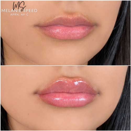 Lip Augmentation Before & After Photos by Flawless Medspa in Las Vegas NV