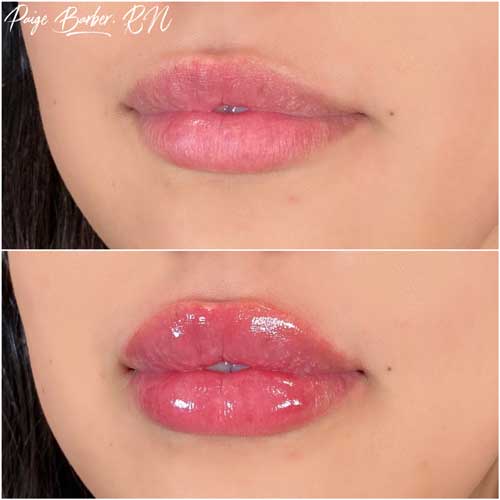 Lip Augmentation Before & After Photos by Flawless Medspa in Las Vegas NV