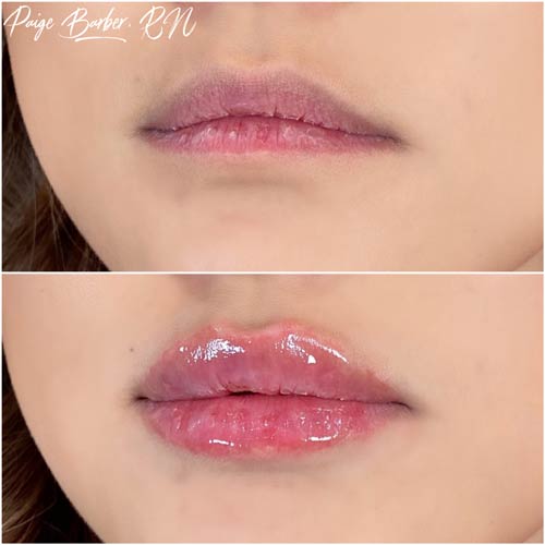 Lip Augmentation Before & After Photos by Flawless Medspa in Las Vegas NV