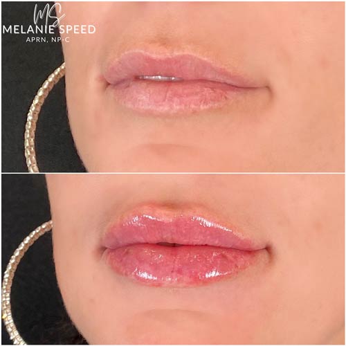 Lip Augmentation Before & After Photos by Flawless Medspa in Las Vegas NV