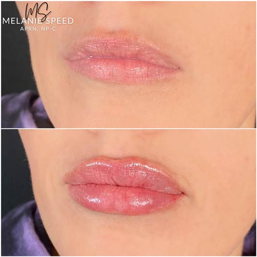 Lip Augmentation Before & After Photos by Flawless Medspa in Las Vegas NV