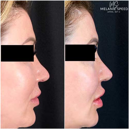 Nose Correction by Flawless Medspa