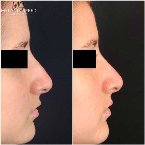 Nose Correction by Flawless Medspa