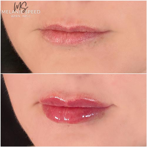 Lip Augmentation Before & After Photos by Flawless Medspa in Las Vegas NV