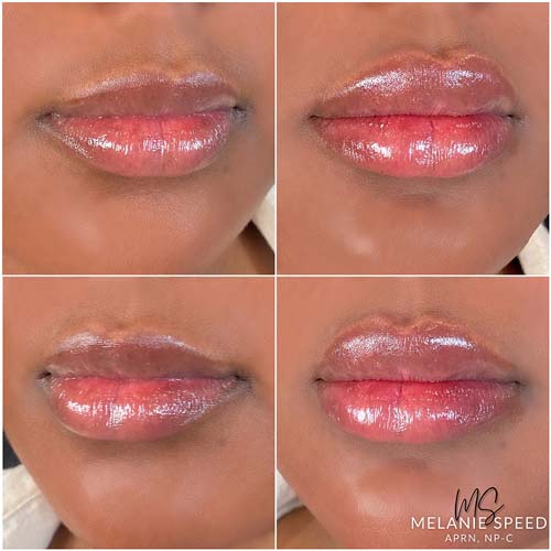 Lip Augmentation Before & After Photos by Flawless Medspa in Las Vegas NV