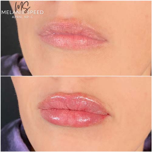 Lip Augmentation Before & After Photos by Flawless Medspa in Las Vegas NV