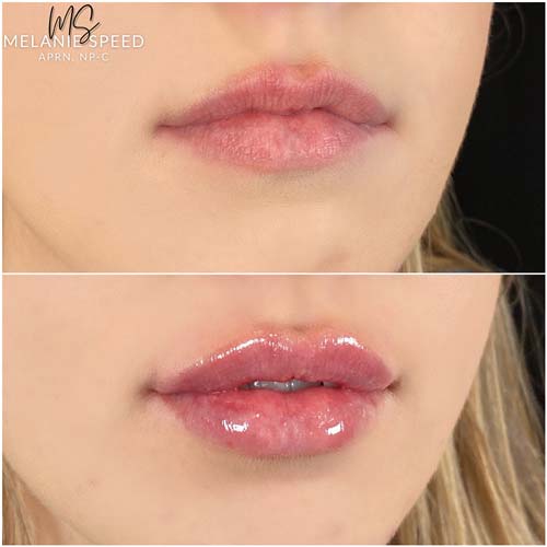 Lip Augmentation Before & After Photos by Flawless Medspa in Las Vegas NV