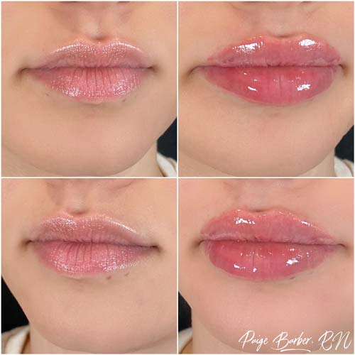 Lip Augmentation Before & After Photos by Flawless Medspa in Las Vegas NV