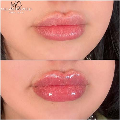 Lip Augmentation Before & After Photos by Flawless Medspa in Las Vegas NV