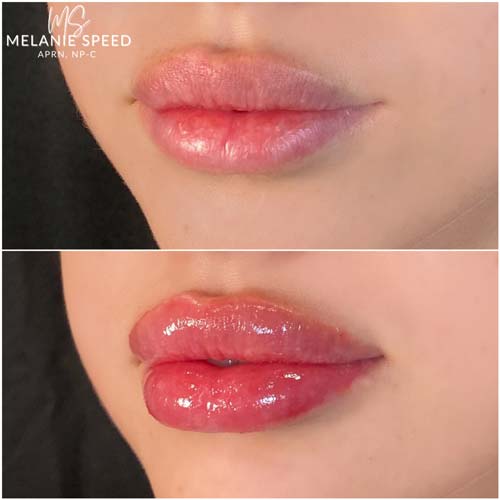 Lip Augmentation Before & After Photos by Flawless Medspa in Las Vegas NV