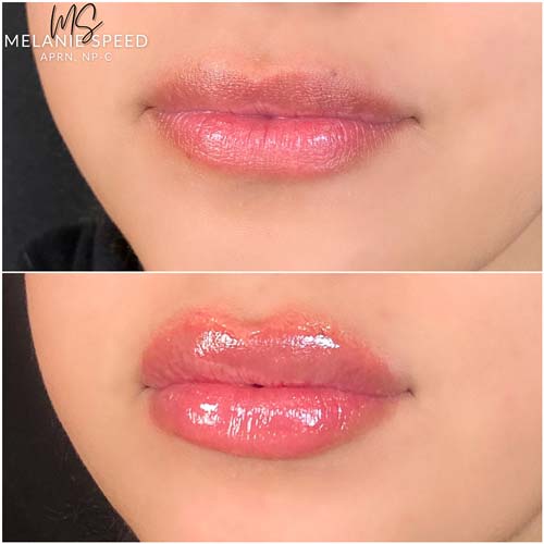 Lip Augmentation Before & After Photos by Flawless Medspa in Las Vegas NV