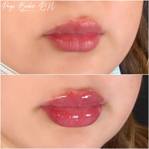 Lip Augmentation Before & After Photos by Flawless Medspa in Las Vegas NV