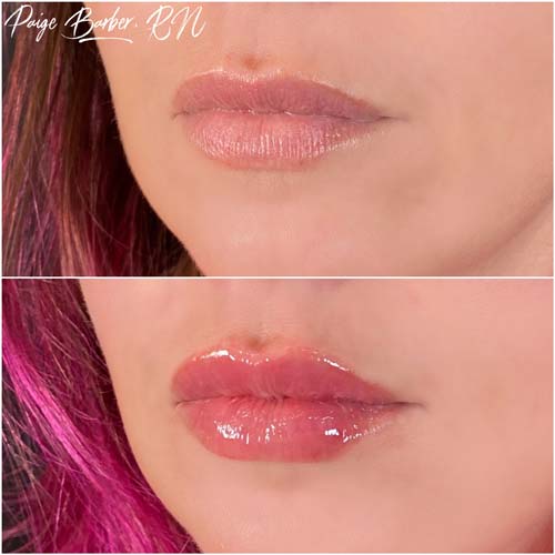 Lip Augmentation Before & After Photos by Flawless Medspa in Las Vegas NV