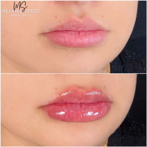 Lip Augmentation Before & After Photos by Flawless Medspa in Las Vegas NV