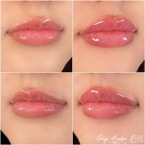 Lip Augmentation Before & After Photos by Flawless Medspa in Las Vegas NV