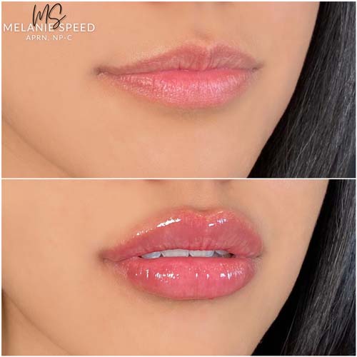 Lip Augmentation Before & After Photos by Flawless Medspa in Las Vegas NV