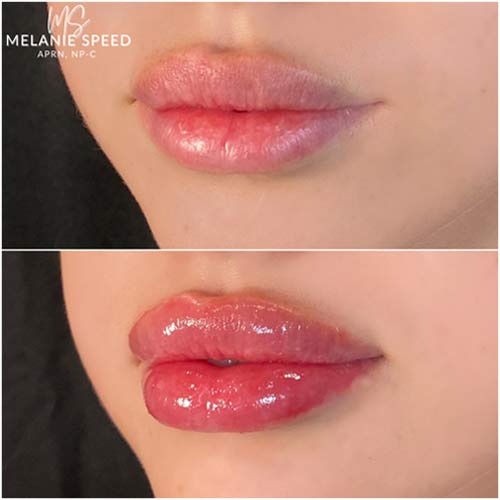 Lip Augmentation Before & After Photos by Flawless Medspa in Las Vegas NV