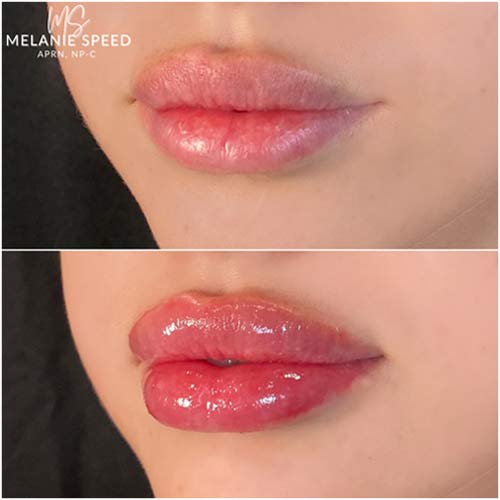 Lip Augmentation by Flawless Medspa Lip Augmentation by Flawless Medspa