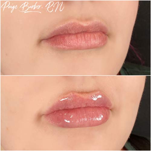 Lip Augmentation Before & After Photos by Flawless Medspa in Las Vegas NV