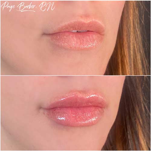 Lip Augmentation Before & After Photos by Flawless Medspa in Las Vegas NV