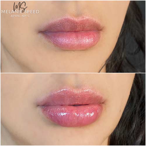 Lip Augmentation Before & After Photos by Flawless Medspa in Las Vegas NV