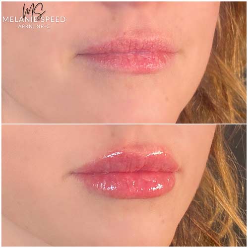 Lip Augmentation Before & After Photos by Flawless Medspa in Las Vegas NV