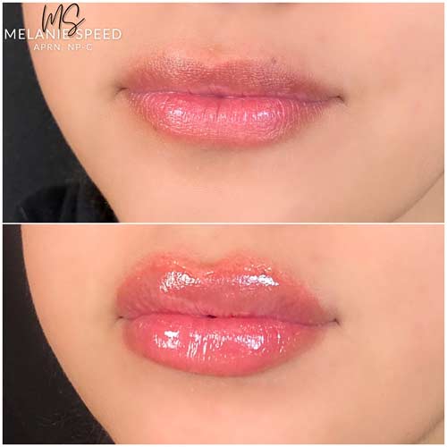 Lip Augmentation Before & After Photos by Flawless Medspa in Las Vegas NV