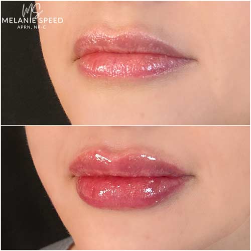 Lip Augmentation Before & After Photos by Flawless Medspa in Las Vegas NV