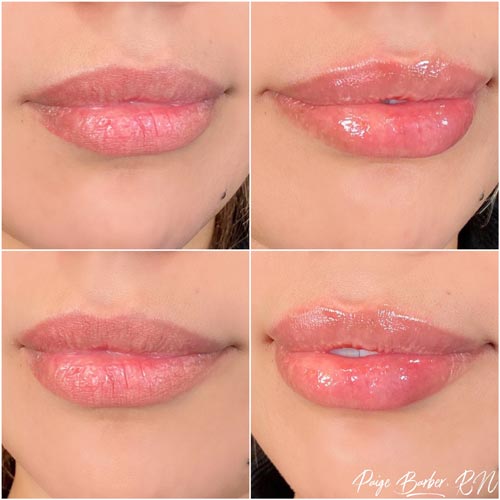 Lip Augmentation Before & After Photos by Flawless Medspa in Las Vegas NV