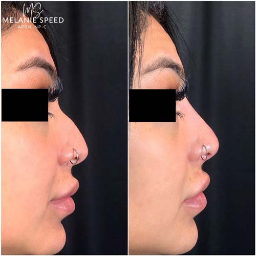 Nose Correction by Flawless Medspa