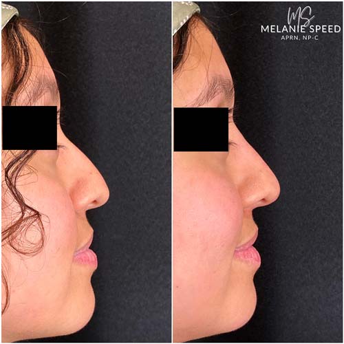 Nose Correction by Flawless Medspa