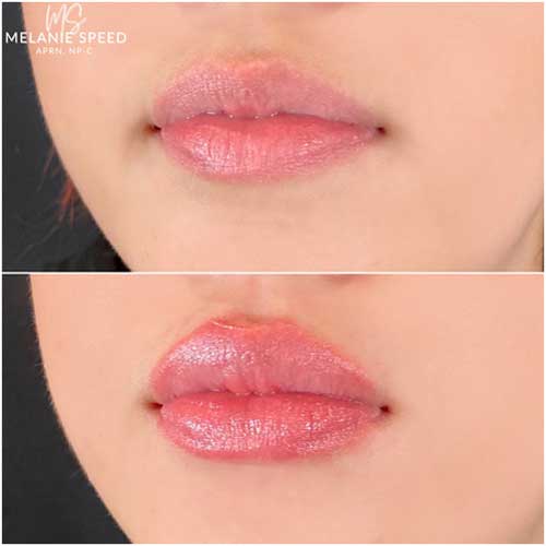 Lip Augmentation by Flawless Medspa