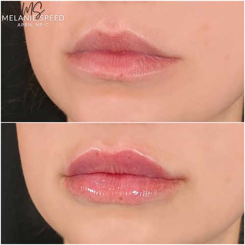 Lip Augmentation by Flawless Medspa