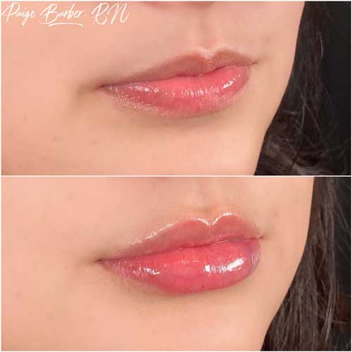 Lip Augmentation by Flawless Medspa