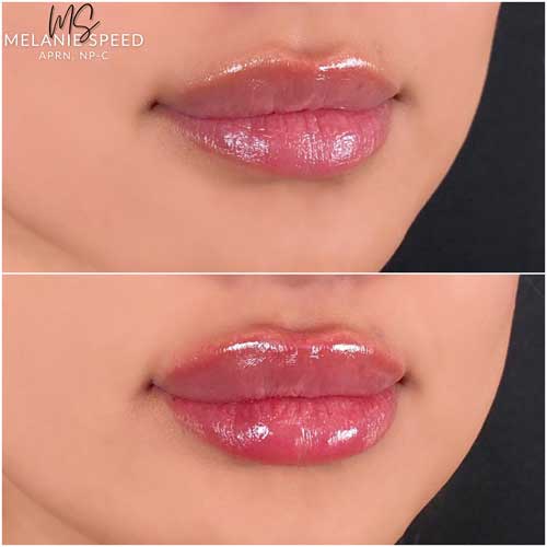 Lip Augmentation by Flawless Medspa