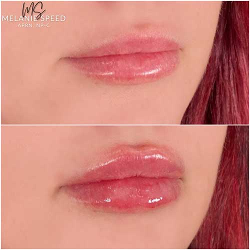 Lip Augmentation by Flawless Medspa