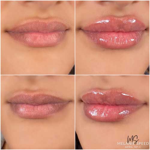 Lip Augmentation by Flawless Medspa