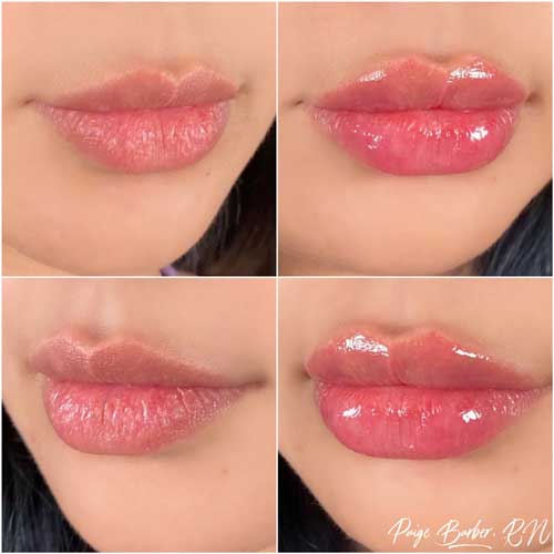 Lip Augmentation by Flawless Medspa