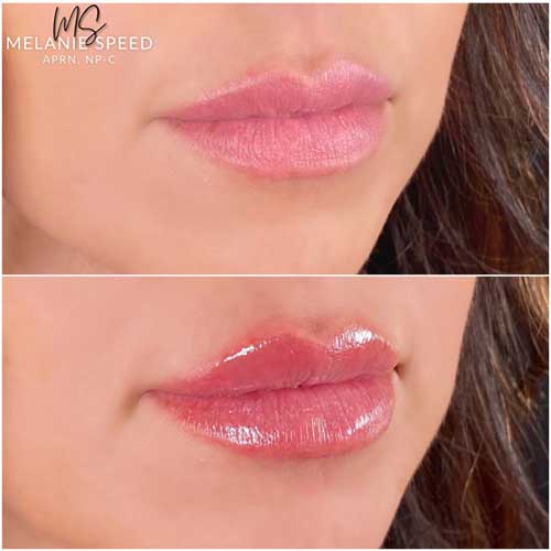 Lip Augmentation by Flawless Medspa