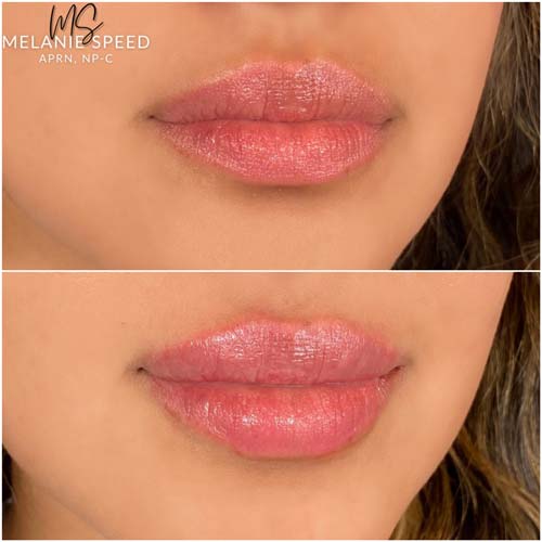 Lip Augmentation Before & After Photos by Flawless Medspa in Las Vegas NV