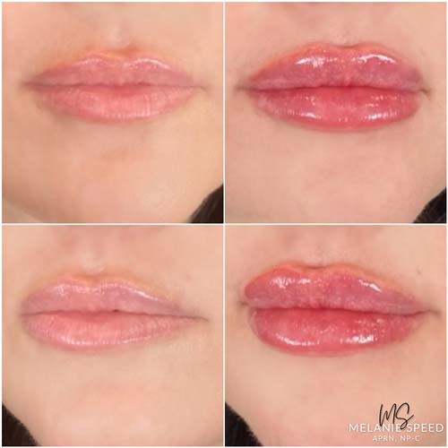 Lip Augmentation Before & After Photos by Flawless Medspa in Las Vegas NV