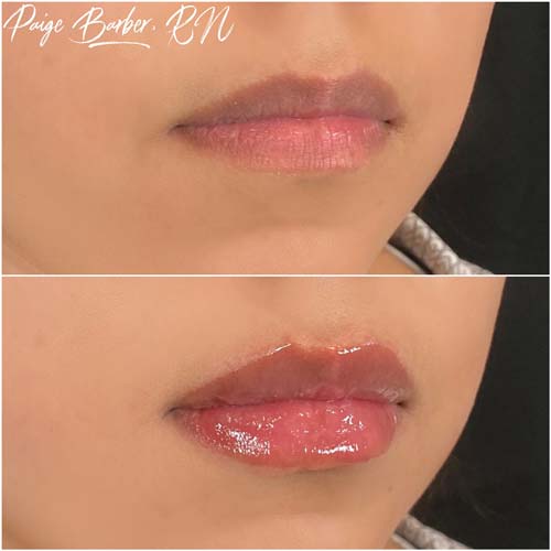 Lip Augmentation Before & After Photos by Flawless Medspa in Las Vegas NV