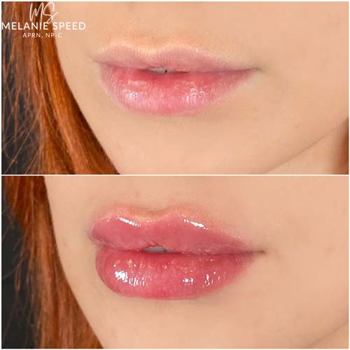 Lip Augmentation Before & After Photos by Flawless Medspa in Las Vegas NV