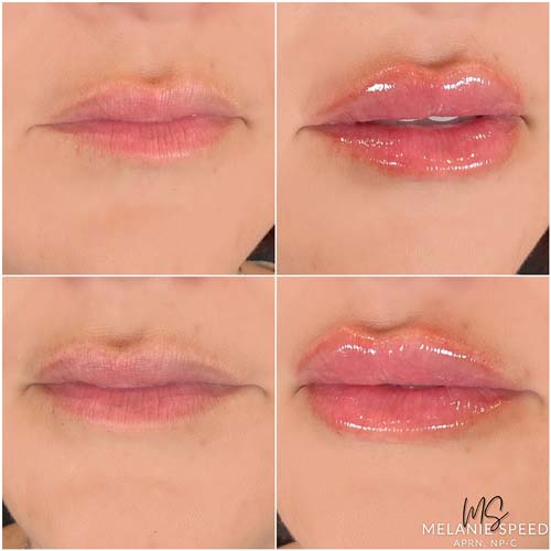 Lip Augmentation Before & After Photos by Flawless Medspa in Las Vegas NV