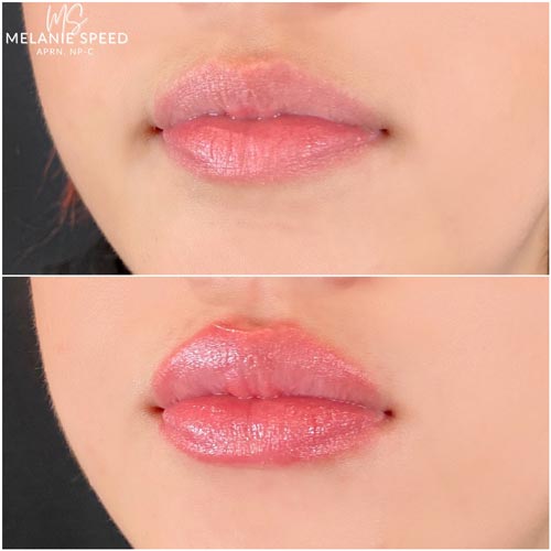 Lip Augmentation Before & After Photos by Flawless Medspa in Las Vegas NV